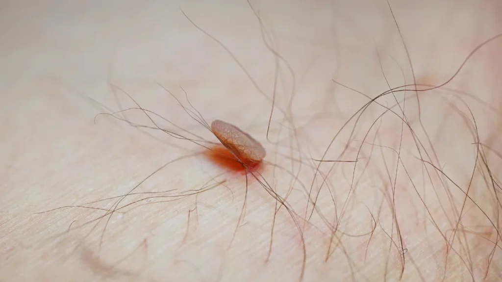 Skin Tags Cancerous