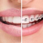 Braces vs Aligners