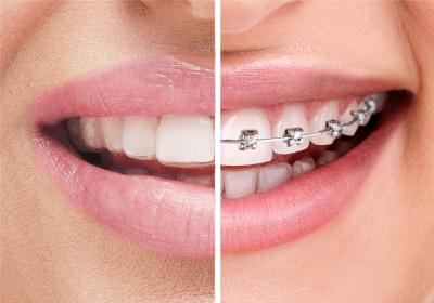 Braces vs Aligners